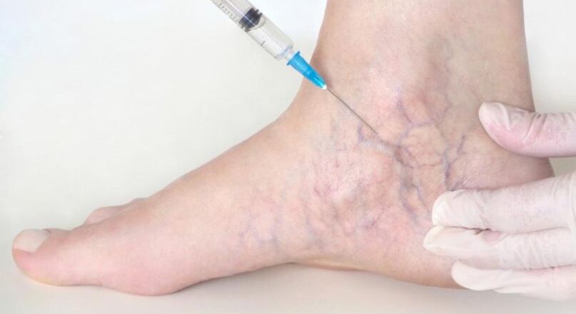 ഇടയ്ക്കിടെ കൈ കുലുക്കാറുണ്ടോ? ഡൊണാള്‍ഡ് ട്രംപിന് നീര്‍വീക്കത്തിനു കാരണമാകുന്ന രോഗം