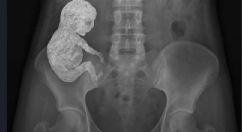 അമ്മയുടെ ശരീരത്തില്‍ കാൽസ്യം നിറഞ്ഞ ‘സ്റ്റോൺ ബേബി’, അമ്പരന്ന് ലോകം