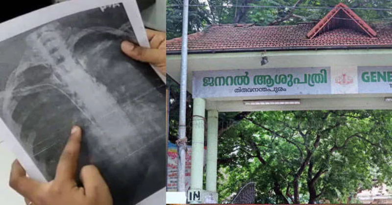 യുവതിയുടെ നെഞ്ചില് ട്യൂബ് കുടുങ്ങിയ സംഭവം; ശസ്ത്രക്രിയ പിഴവില് ഡോക്ടര്ക്കെതിരെ കേസ്