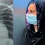 ചികിത്സാപിഴവ്: നെഞ്ചിനുള്ളിൽ ഗൈഡ് വയർ കുടുങ്ങിയ യുവതി കോടതിയിലേക്ക്; ഒരു കോടി രൂപ നഷ്ടപരിഹാരം ആവശ്യപ്പെട്ടു