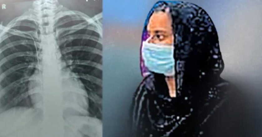 ചികിത്സാപിഴവ്: നെഞ്ചിനുള്ളിൽ ഗൈഡ് വയർ കുടുങ്ങിയ യുവതി കോടതിയിലേക്ക്; ഒരു കോടി രൂപ നഷ്ടപരിഹാരം ആവശ്യപ്പെട്ടു