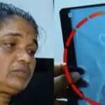 വയറ്റിൽ കുടുങ്ങിയ കത്രിക നീക്കി: ഉഷ ജോസഫിന്റെ ശസ്ത്രക്രിയ വിജയകരം